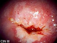 Der erreger des hpv verursacht geschlechtskrankheiten und kann sich durch warzen an der. Fachbegriffe | Dysplasie | Krebsabstrich | PAP