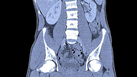 Abdominal Ct Scans Definition Uses Picture And More