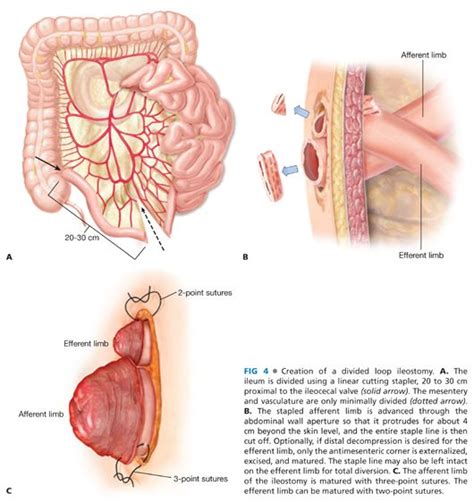 End And Diverting Loop Ileostomies Creation And Reversal Abdominal Key