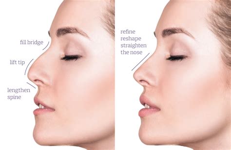 Nose Thread Lift Procedures Enquire At Me Clinic Today