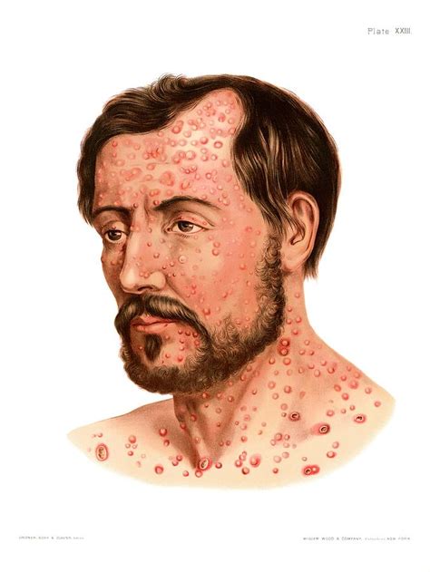 Secondary Syphilis Rash Photograph By Us National Library Of Medicine