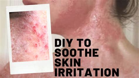 Soothe Your Skin From Irritation At Home Youtube