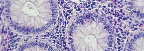 Colon cancer is the second deadliest form of cancer in the u.s., yet it doesn't have to be. Colon Cancer - Orange County Hemorrhoid Clinic