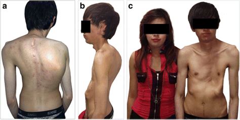 Skeletal Manifestations Of Marfan Syndrome Associated To Heterozygous