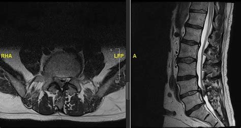 Preoperative Mri Scan Showing L45 Disc Prolapse Download Scientific