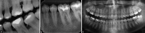 A Intraoral Bitewing Dental X Ray Image B Intraoral Periapical