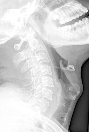 Foreign Bodies On Lateral Neck Radiographs In Adults Imaging Findings