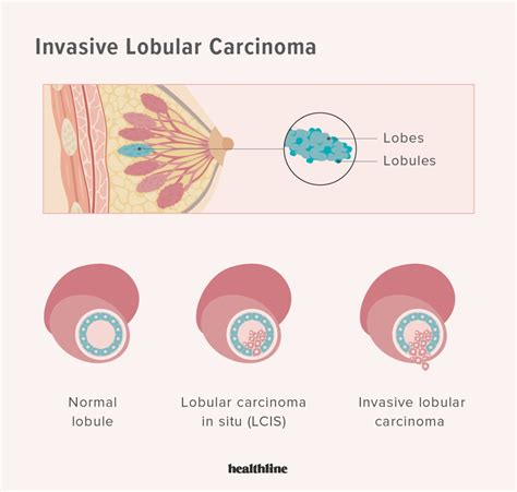 Types Of Breast Cancer Common Types Other Types Stats