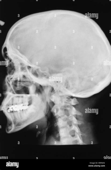 Normal Skull X Ray Stock Photo Alamy