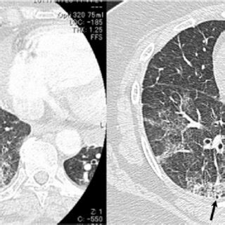 High Resolution CT HRCT Demonstrates Ground Glass Opacities