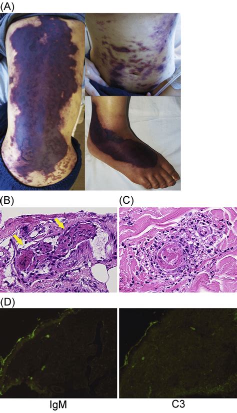 Figure1macroscopic And Microscopic Findings Of The Skin Lesion A