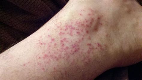 Diabetic Rash On Legs Pictures Symptoms And Pictures