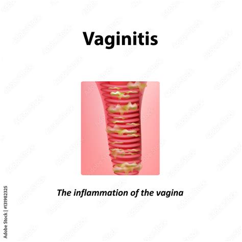 Inflammation Of The Vagina Vaginitis Infographics Vector