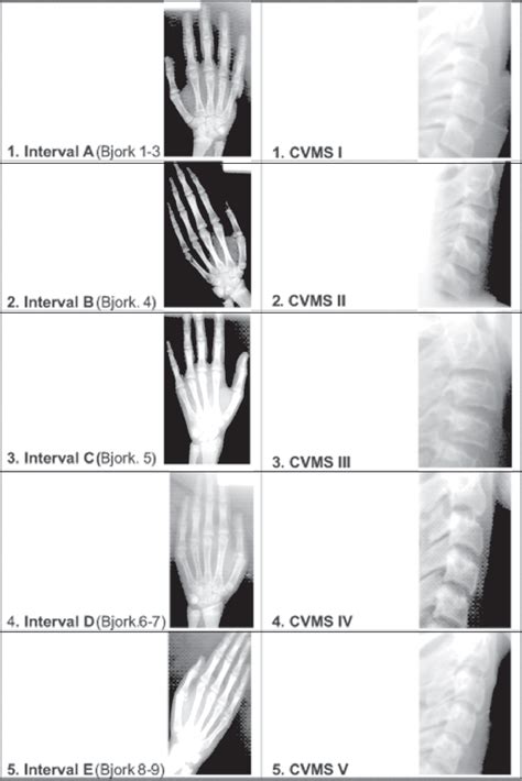 Comparative Evaluation Between Cervical Vertebrae And Hand Wrist