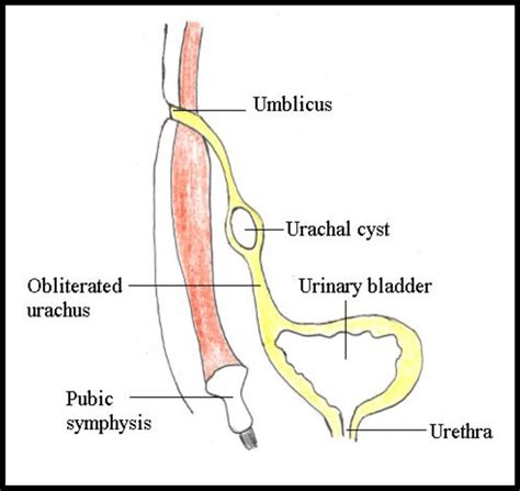 Urachal Cyst Histology