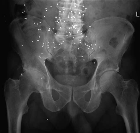 Shotgun pellets - Radiology at St. Vincent's University Hospital