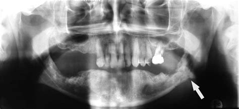 Imaging Findings Of Bisphosphonate Associated Osteonecrosis Of The Jaws