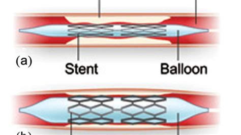 Coating Techniques And Release Kinetics Of Drug Eluting Stents