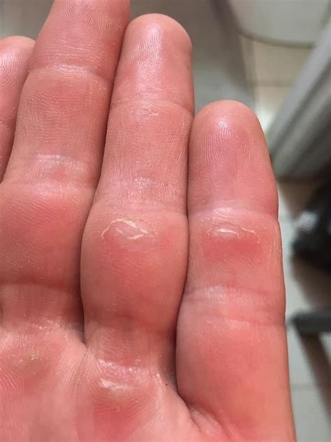 I Have Small Calluses Inside Bigger Calluses On My Hands Small Mask