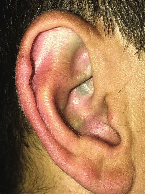 Ochronosis Ear