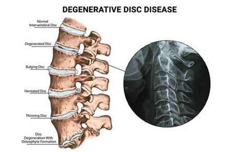 Cervical Degenerative Disc Disease Treatment In New Jersey By Nu Spine