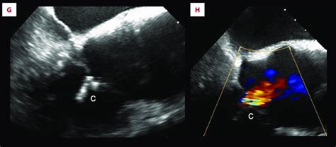 Intraprocedural Images Of The Percutaneous Edge To Edge Tricuspid Valve