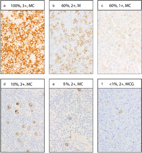 Examples Of Cd30 Expression Levels Detected By Immunohistochemistry