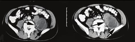Axial Contrast Enhanced Abdominal Computed Tomography Ct Scans