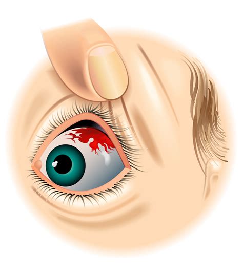 7 Causes Of A Red Spot On Your Eye And How To Treat Them