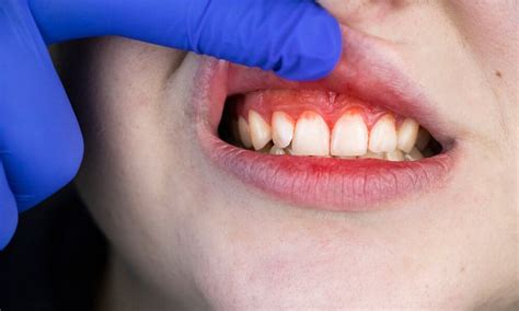 Why Are My Gums Itchy Itchy Gums Impact Your Oral Health