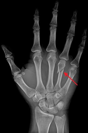 Symptoms include pain and a depressed knuckle. Boxer's fracture - Wikipedia, the free encyclopedia