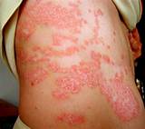 What Is The Latest Treatment For Psoriasis Images