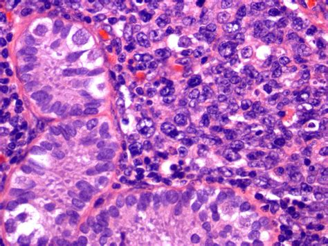 Pathology Outlines Primary Follicular Lymphoma Testis