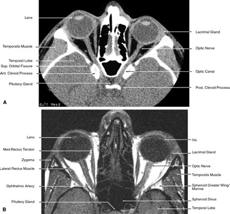 Radiology Anatomy Images Orbit Ct Scan Anatomy