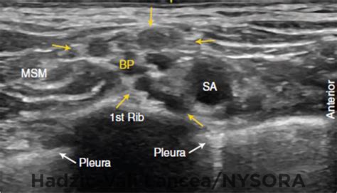 Ultrasound Guided Supraclavicular Brachial Plexus Block Nysora The
