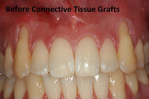 Gum Pain Gum Loss Grafting