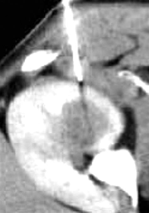 Imaging Guided Percutaneous Renal Biopsy Rationale And Approach Ajr