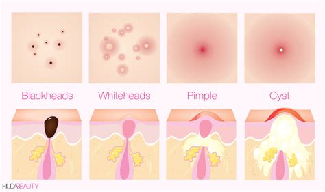 How To Treat Cystic Acne At Home Blog Huda Beauty