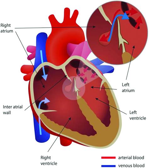 Patent Foramen Ovale Practical Neurology