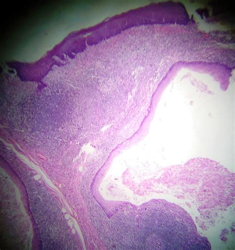 Pathology Outlines Dermoid Epidermoid Cyst