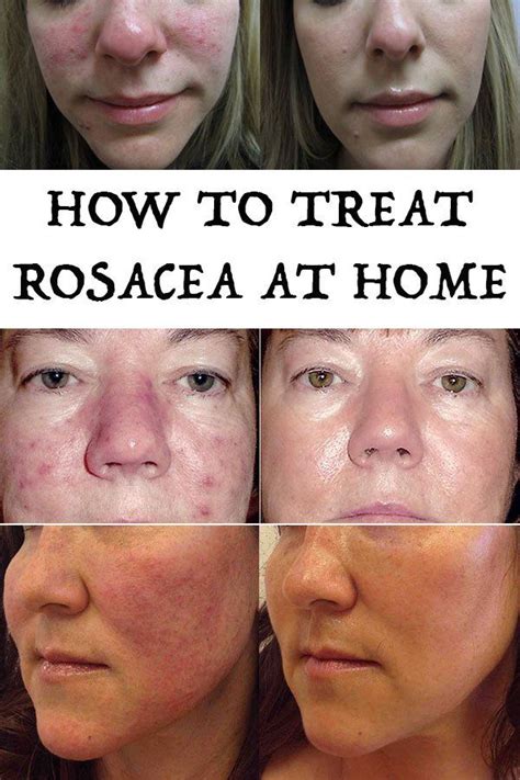 How To Treat Rosacea At Home How To Treat Rosacea Rosacea Rosacea