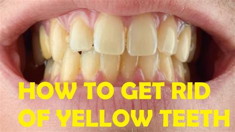 How To Get Rid Of Yellow Stains On Teeth Near Gums Youtube