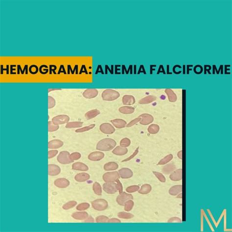 Hemograma Na Anemia Falciforme Importância E Marcadores Clínicos Inml