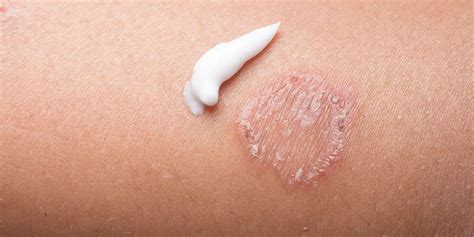 Skin Infections Cibolo Creek Dermatology Group