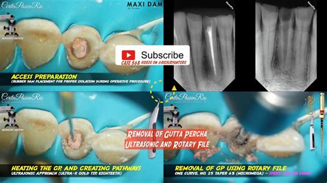 Gutta Percha Removal During Endodontic Retreatment With Rotary File And