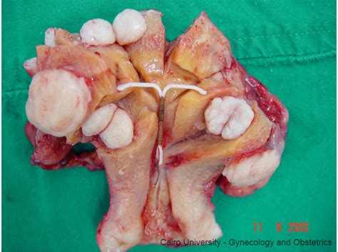 Maka, tidak hairanlah fibroid boleh ditemui dalam kalangan wanita yang hamil. MummySayf : GLA COMPLEX PUNCA RAHIM BENGKAK