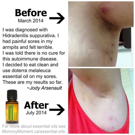 Healthy Eating Essential Oils And Pictures Of My Disease