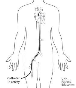 Diagram of a male upper leg. Angiogram | Cardiac College