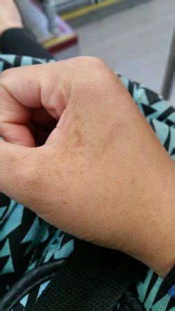 Apply it on brown spots using cotton ball and rinse it off after it dries completely. Brown spots..? - BabyCenter