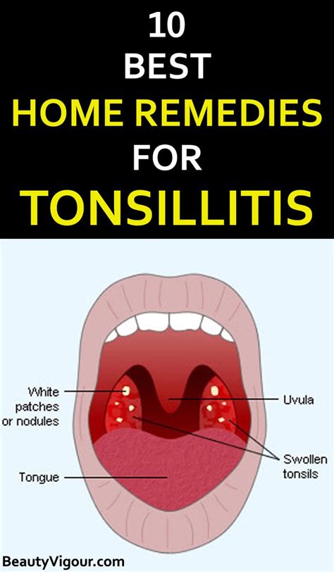 Bacterial Tonsillitis Symptoms In Adults